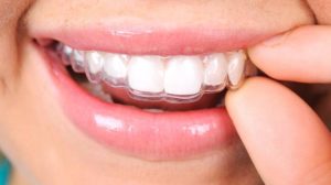 Tipos de ortodoncia invisible